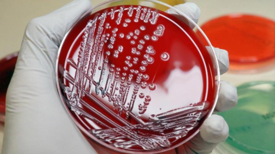 Superbug Reaches the U-S-_31456047-159532