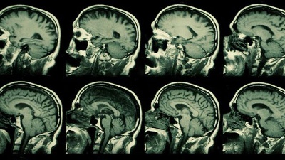 MRI--X-ray--brain-jpg_20160422103410-159532