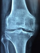 knee xray_1467062839013.jpg